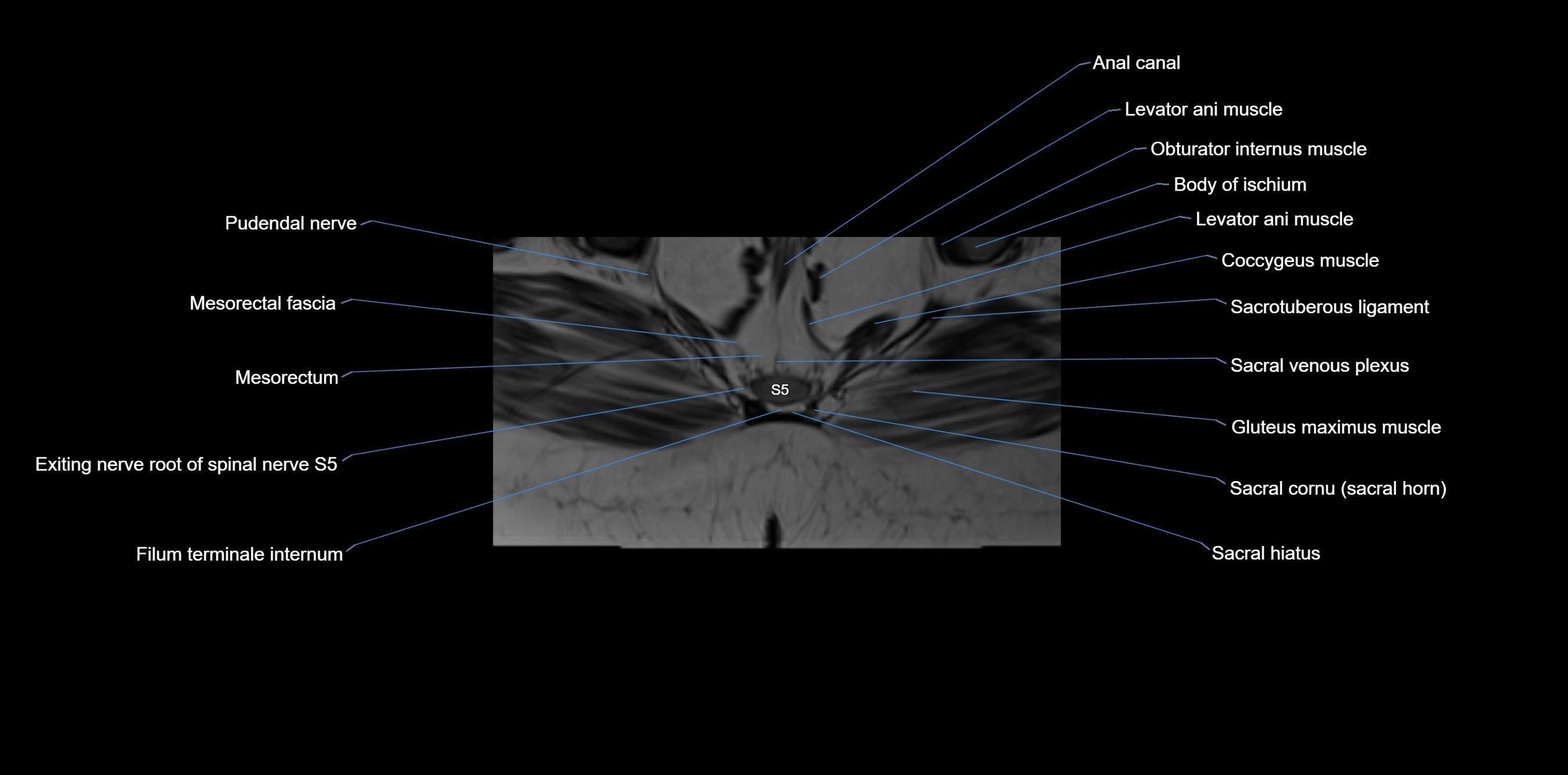 MRI sacrum, coccyx and sacroiliac joint axial cross sectional anatomy 3T  radiology  image-img-00001-00063.webp